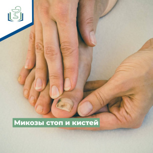 Микозы стоп и кистей