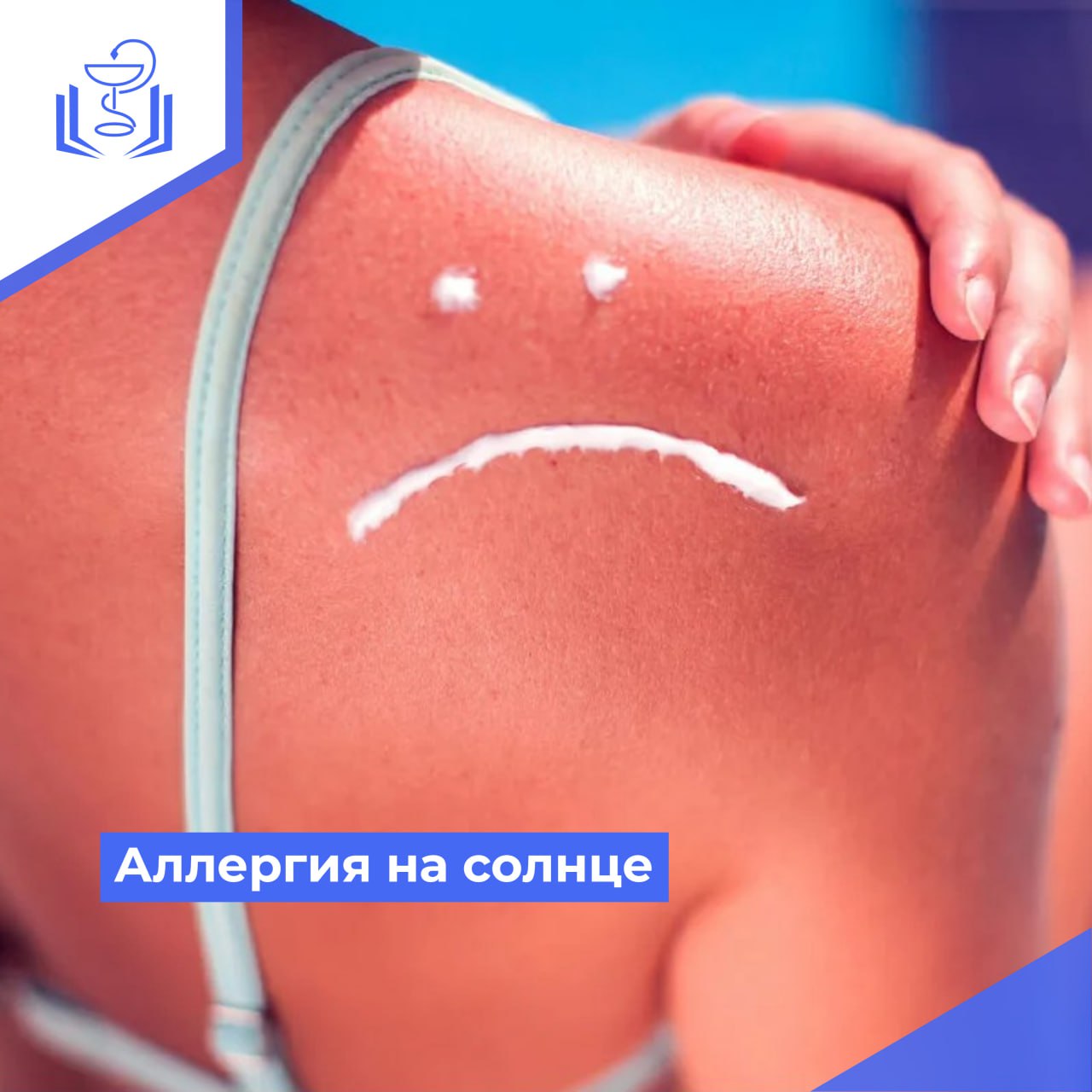 Аллергия на солнце Аллергия на солнце
