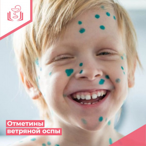 Отметины ветряной оспы