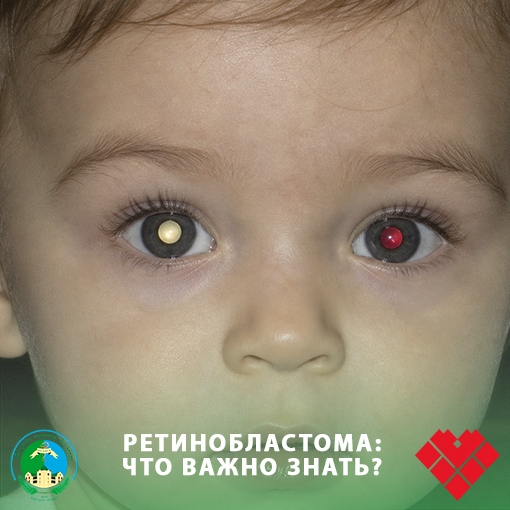Ретинобластома: что важно знать? Ретинобластома: что важно знать?