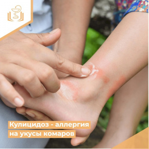 Кулицидоз - аллергия на укусы комаров