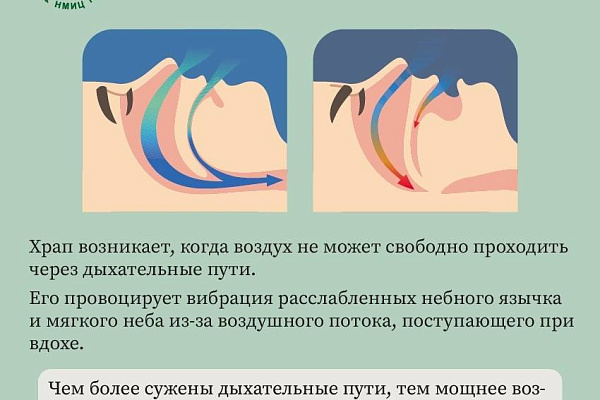 Ночной враг: почему возникает храп и как с ним справиться?