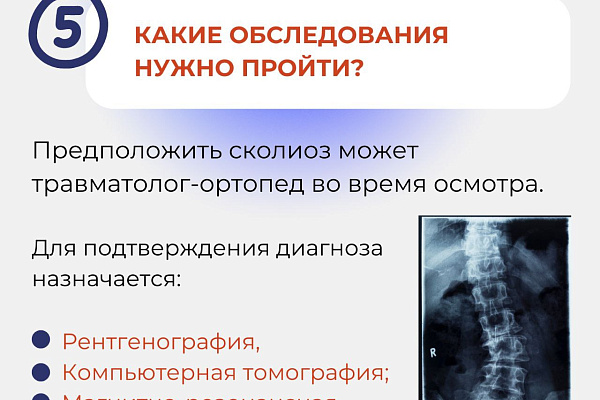 6 вопросов о сколиозе