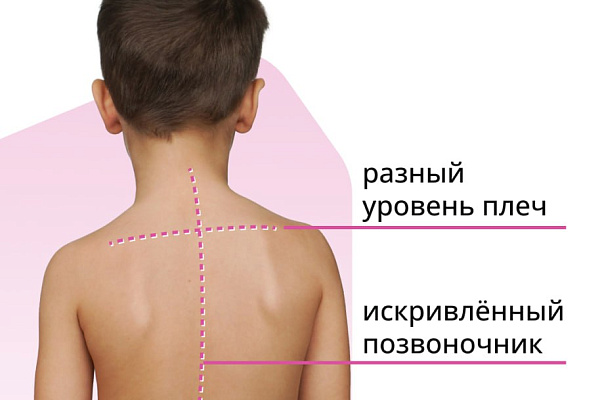 Как не допустить развития сколиоза у ребёнка?
