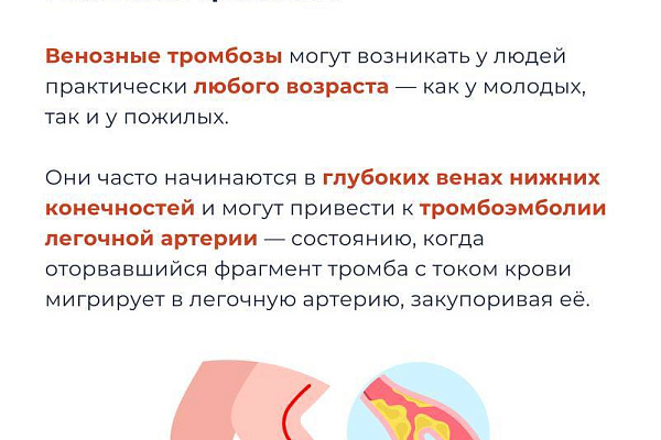 Откуда берутся тромбы и как снизить риски