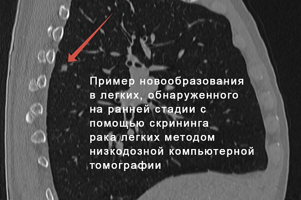 Скрининг рака лёгких методом низкодозной компьютерной томографии
